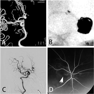 Risk Factors of Transient Cortical Blindness After Cerebral Angiography: A Multicenter Study